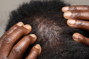 Effective Minoxidil Foam Solutions for Men